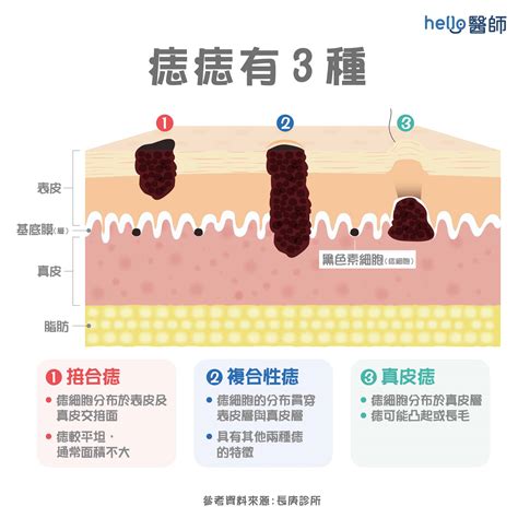 痣 有毛|痣變大、痣多或長毛會變皮膚癌？認識痣的形成與原因